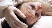 Smallpox latest